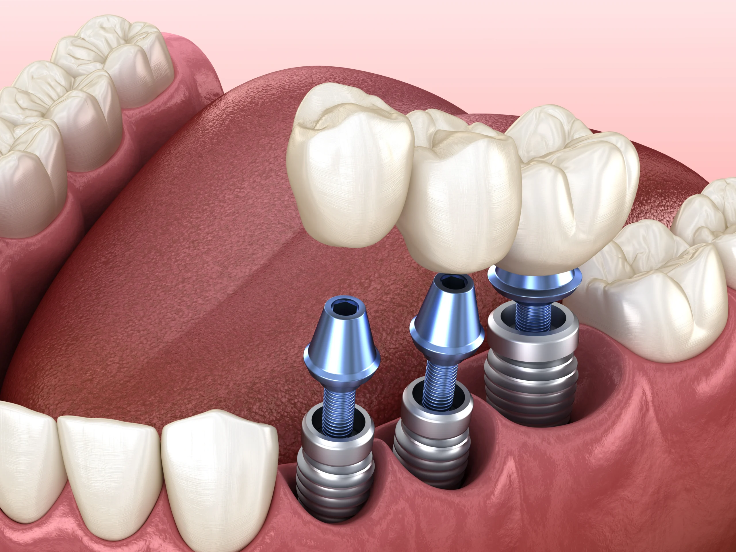 A model of teeth with implants.